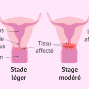 Cancer uterus
