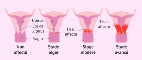 Cancer uterus
